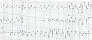 Hemiblock | ECG Guru - Instructor Resources