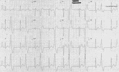 ECG in Congenital Heart Disease - ECGpedia