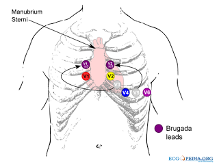 Dr. Smith's ECG Blog: Brugada pattern induced by tricyclic