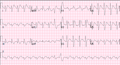 Tom Evans' ECG Cribsheets - Palm Version - UCSF