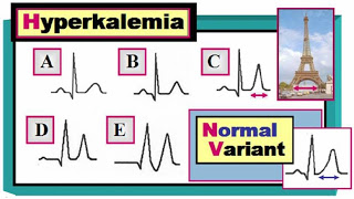 Asx Patient, Abnormal EKG | MaziqueMedicine