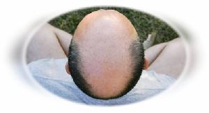 Male pattern baldness: MedlinePlus Medical Encyclopedia