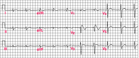 Brugada syndrome - Genetics Home Reference - Your guide to