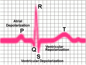 S1Q3T3 EKG Classic Pattern in Pulmonary Embolism (Example).