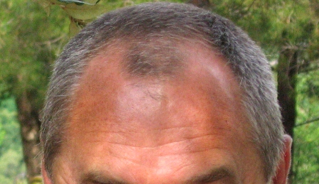 Male Pattern Baldness - Symptoms, Diagnosis, Treatment of