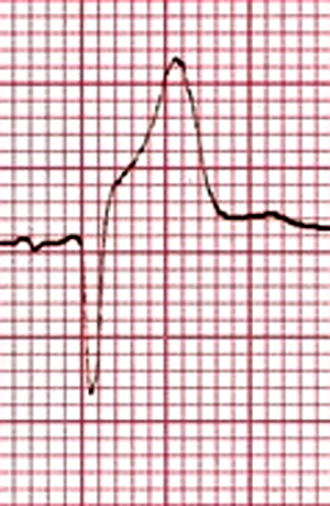 Brugada Syndrome - Medscape Reference