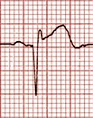 Amal Mattu's Emergency ECG Video of the Week
