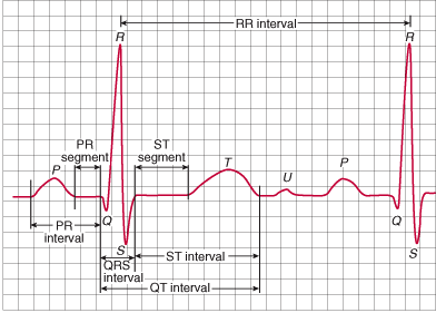 Brugada Syndrome - LHSC