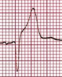 Brugada syndroom | Cardiogenetica AMC, Amsterdam